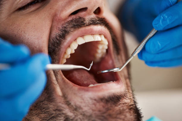Best Emergency Dentist for Lost Fillings or Crowns in Northwest Harbor, NY